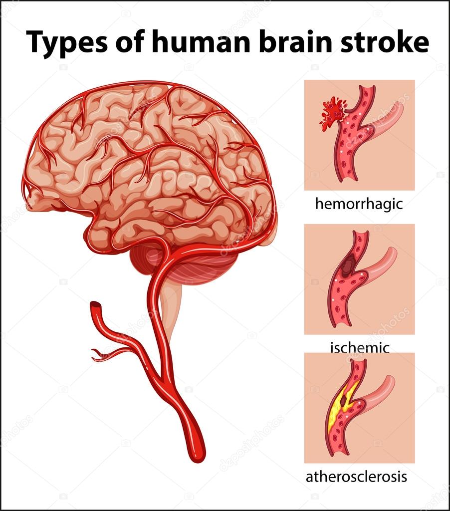 Sabes Que Es Un Accidente Cerebrovascular Los Tipos De Acv Y C Mo