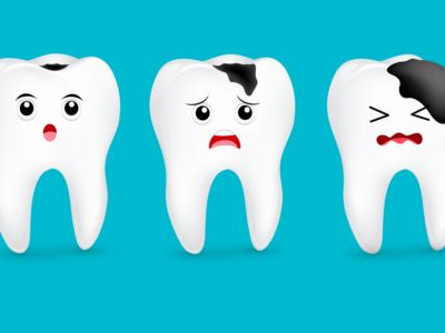 ¿Conoce qué es la caries dental, sus fases y cómo tratarla?